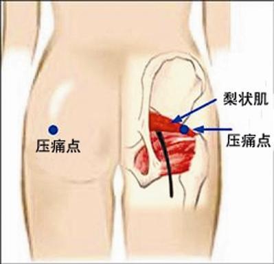 常跑久坐均可引起梨状肌综合征，日常预防有妙招