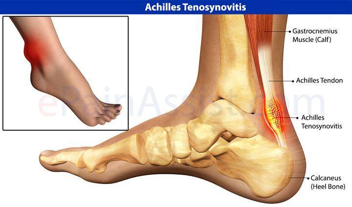 关于跟腱炎(Achilles tendinitis) 
